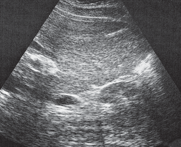 Gallbladder ultrasound image, Kidney, renal vein, colon