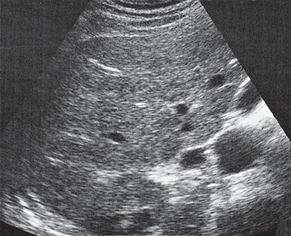 Gallbladder ultrasound image, Kidney, renal vein, vena cava, liver