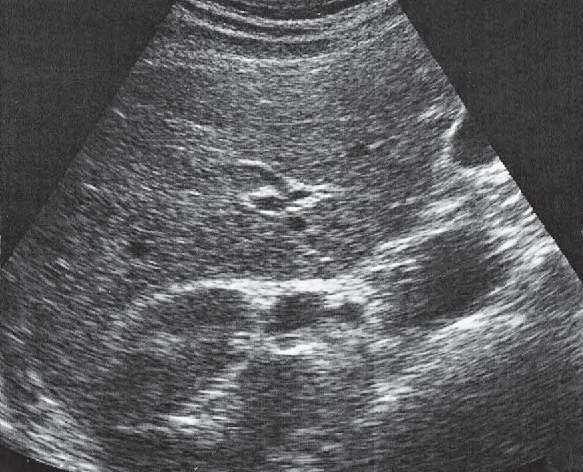 Right kidney ultrasound image, Kidney, renal vein, renal artery, vena cava, liver