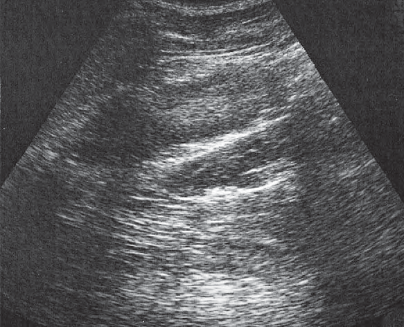 Spleen ultrasound image, Kidney, spleen, psoas muscle