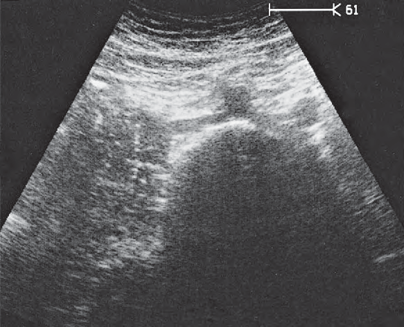 Artifact ultrasound image, Iliac arteries