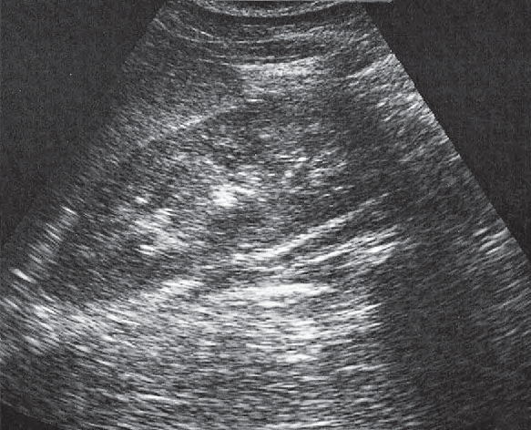 Spleen ultrasound image, Kidney, spleen, psoas muscle