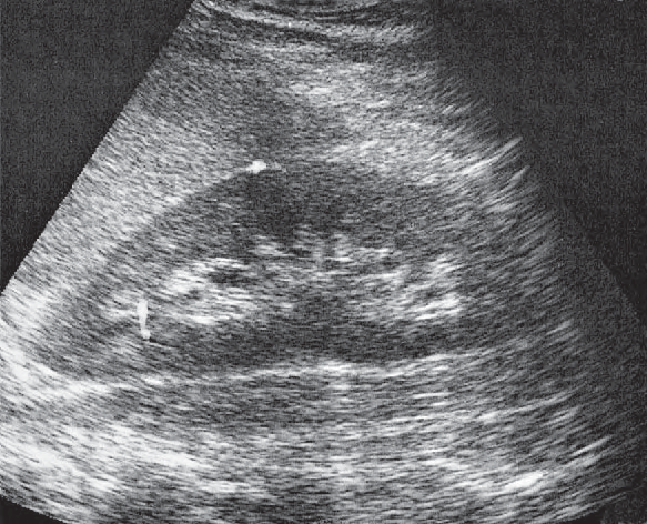 Spleen ultrasound image, Kidney, spleen, psoas muscle