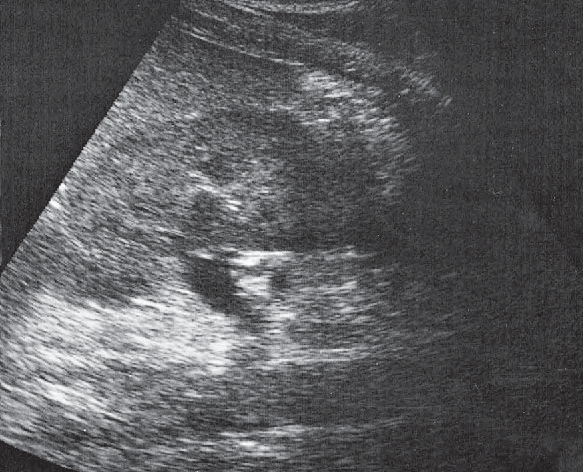 Spleen ultrasound image, Kidney, renal vein, spleen, aorta