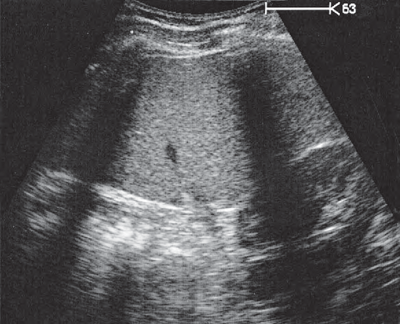 Spleen ultrasound image, Kidney, spleen, bowel