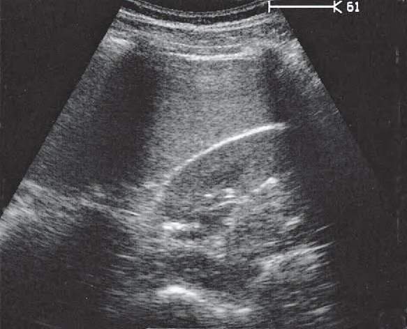 Spleen ultrasound image, Kidney, spleen, psoas muscle