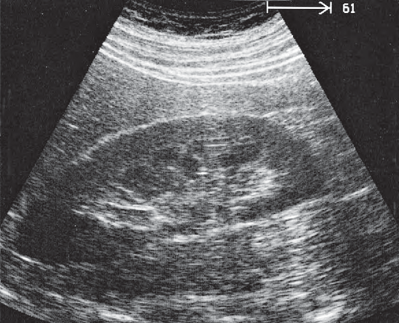 Pyramids Ultrasound Anatomy