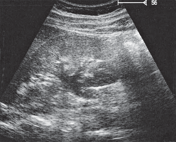 Renal cortex ultrasound image, Collecting system
