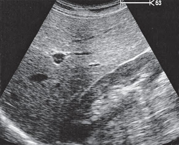 Right kidney ultrasound image, Kidney, liver