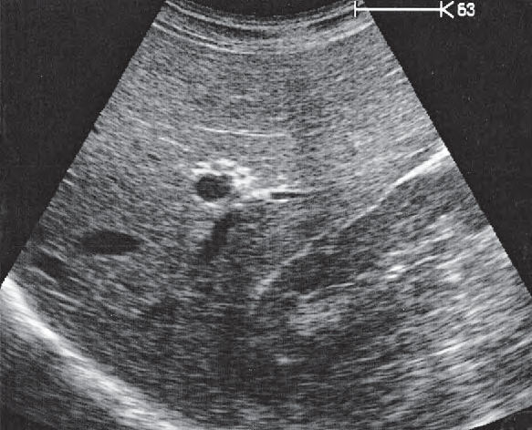 Right kidney ultrasound image, Kidney, liver
