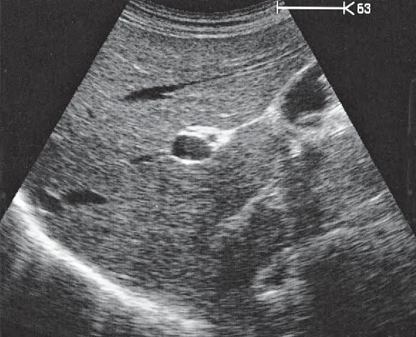 Adrenal Gland Ultrasound Anatomy