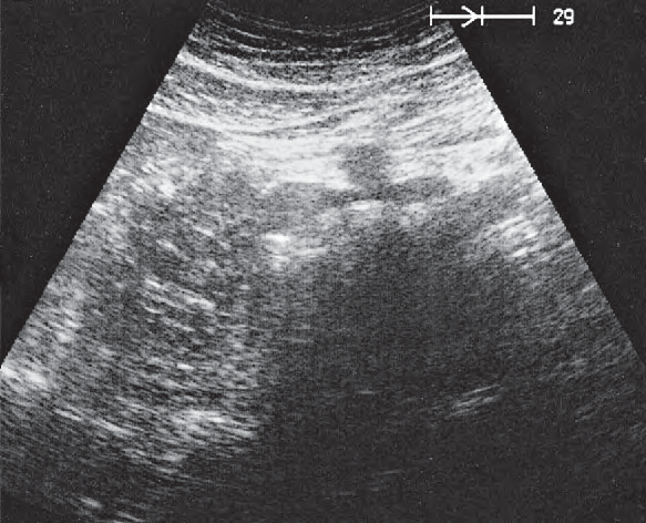 Iliac Vein Ultrasound Anatomy
