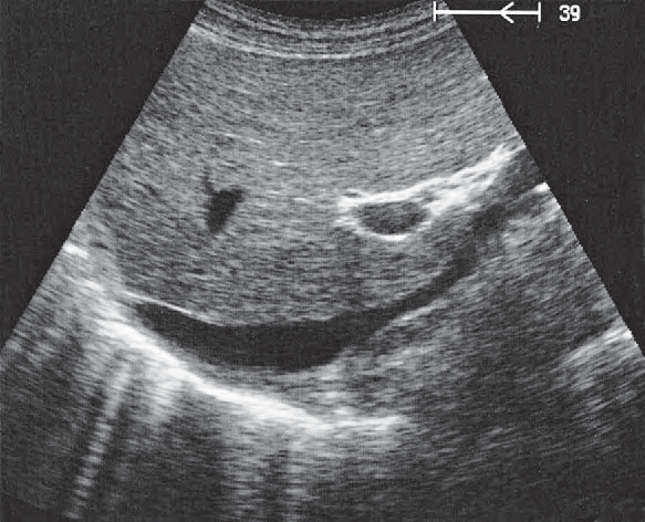 Right renal artery ultrasound image, Adrenal gland, vena cava, renal artery