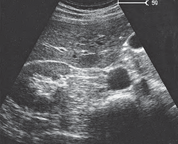 Duodenum ultrasound image, Kidney, vena cava