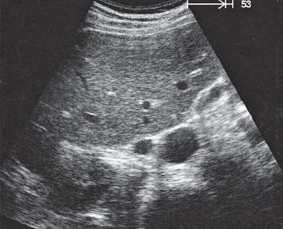 Gallbladder ultrasound image, Kidney, renal vein, vena cava