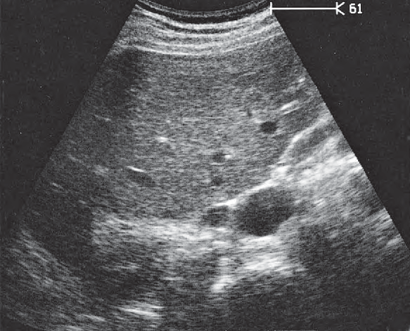 Spinal column ultrasound image, Renal vein, vena cava