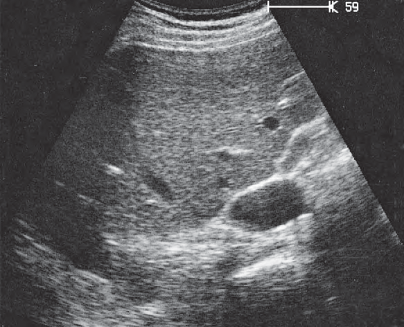 Spinal column ultrasound image, Adrenal gland, vena cava