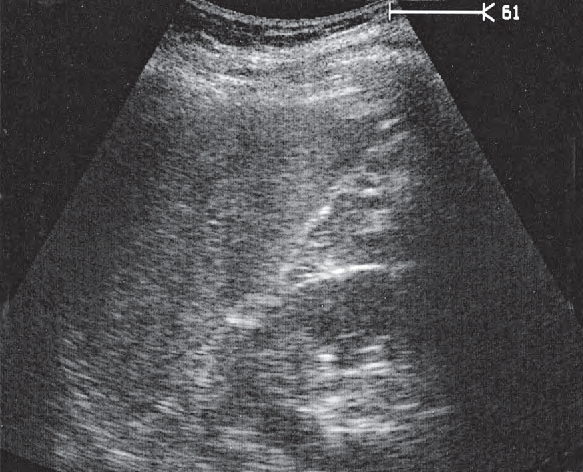 Spleen ultrasound image, Kidney, spleen