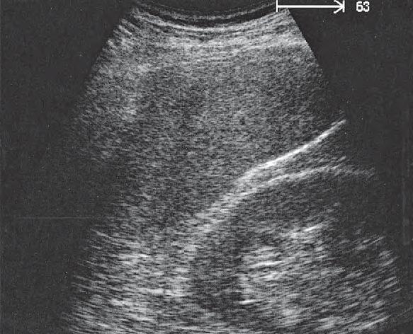 Spleen ultrasound image, Adrenal gland, kidney, spleen