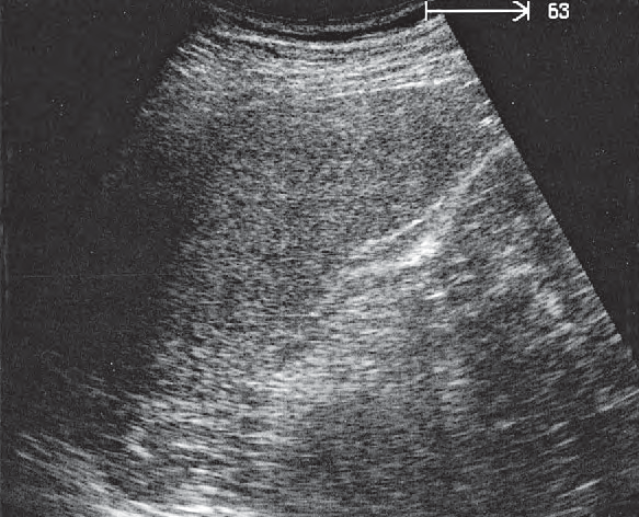 Spleen ultrasound image, Adrenal gland, kidney, spleen