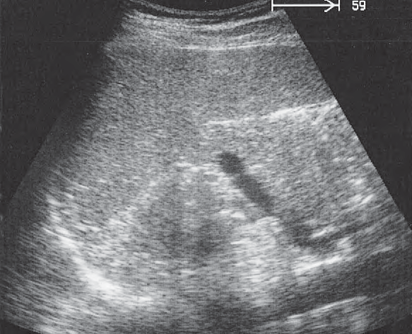 Spleen ultrasound image, Spleen, tail of pancreas