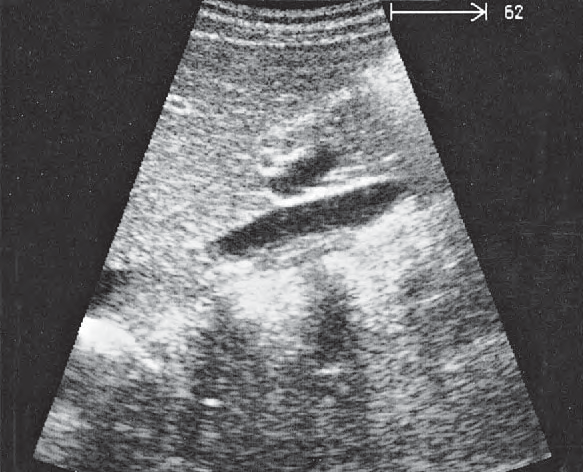 Spinal column ultrasound image, Layers of adrenal gland