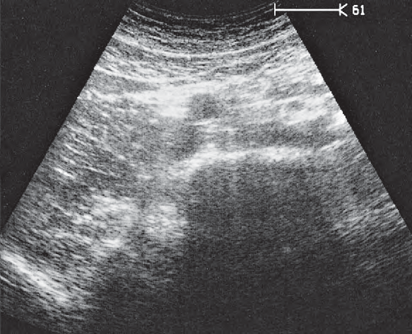 Spinal column ultrasound image, Iliac vessels