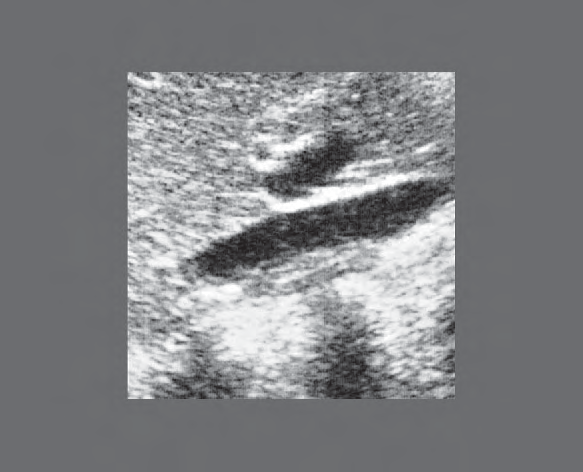 Vena cava ultrasound image, Layers of adrenal gland