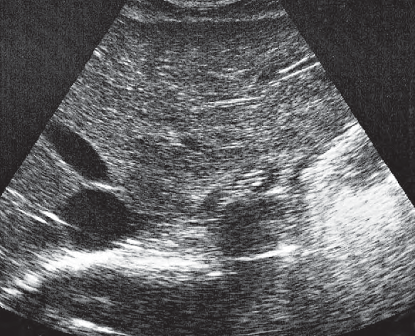 Middle hepatic vein ultrasound image, Esophagus, aorta, liver
