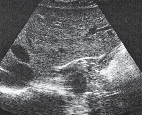 Middle hepatic vein ultrasound image, Cardia, aorta, liver
