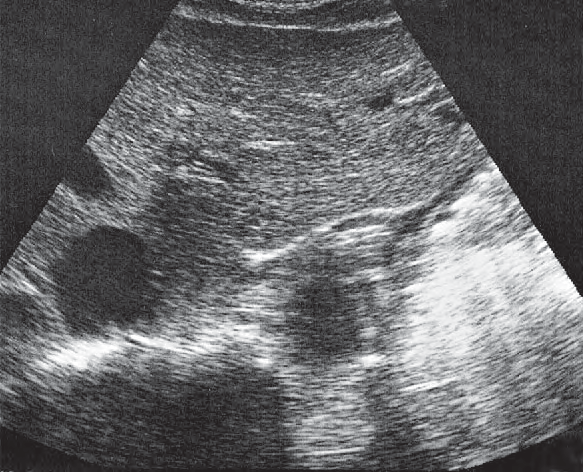 Middle hepatic vein ultrasound image, Cardia, body of stomach, aorta, liver
