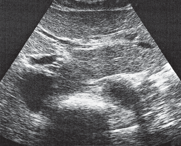 Quadrate lobe ultrasound image, Body of stomach, aorta, liver