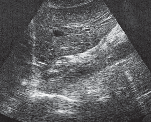 Quadrate lobe ultrasound image, Esophagus, aorta, liver