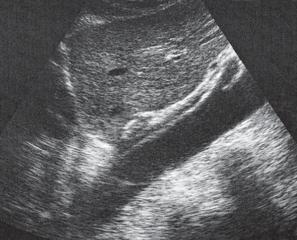 Body of stomach ultrasound image, Esophagus, aorta, liver