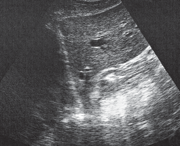 Body of stomach ultrasound image, Cardia, liver
