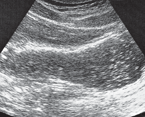 Pancreatic duct ultrasound image, Body of stomach, liver