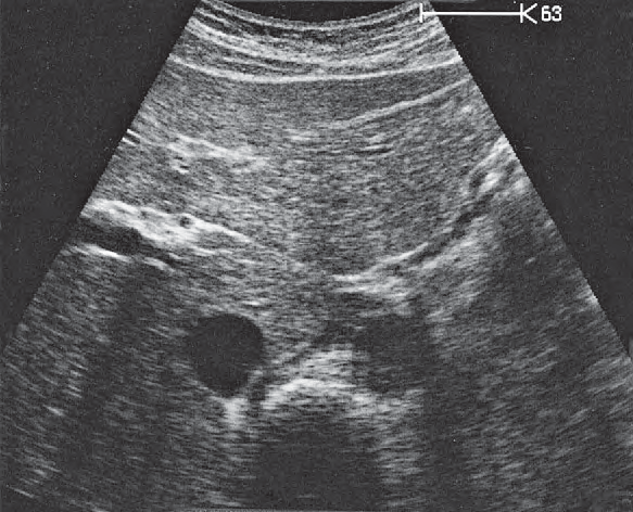 Left Gastric Artery Ultrasound Anatomy