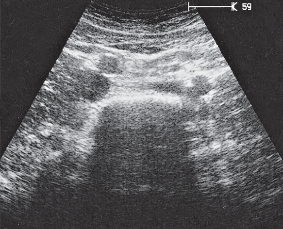 Spinal column ultrasound image, Iliac vessels
