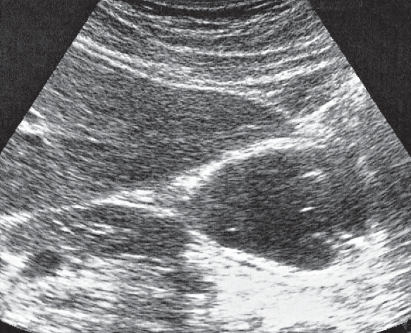 Body of stomach ultrasound image, Antrum, liver, pancreas