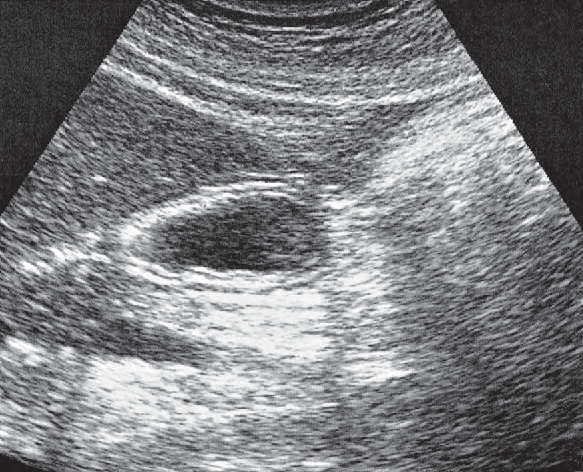 Quadrate lobe ultrasound image, Antrum, liver, pancreas