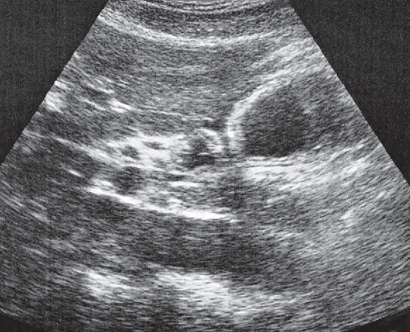Caudate lobe ultrasound image, Pylorus, pancreas, liver