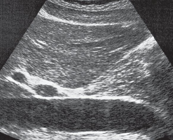 Duodenum ultrasound image, Duodenal bulb, liver, vena cava