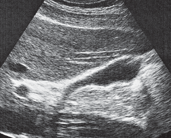Duodenum ultrasound image, Duodenum, gallbladder, vena cava