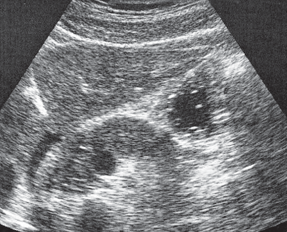 Gallbladder ultrasound image, Antrum, liver, pancreas