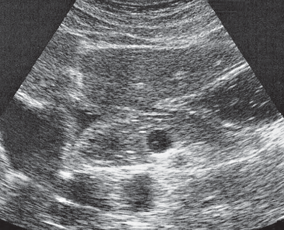 Gallbladder ultrasound image, Antrum, duodenum, liver, pancreas, gallbladder