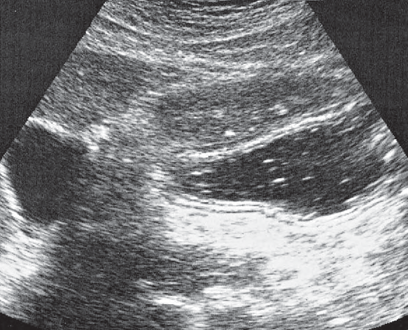Duodenum ultrasound image, Antrum, gallbladder