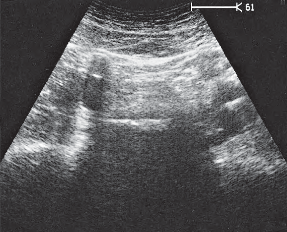 Spinal column ultrasound image, Iliac vessels