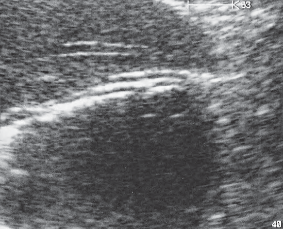 Antrum of stomach ultrasound image, Layers of gastric wall