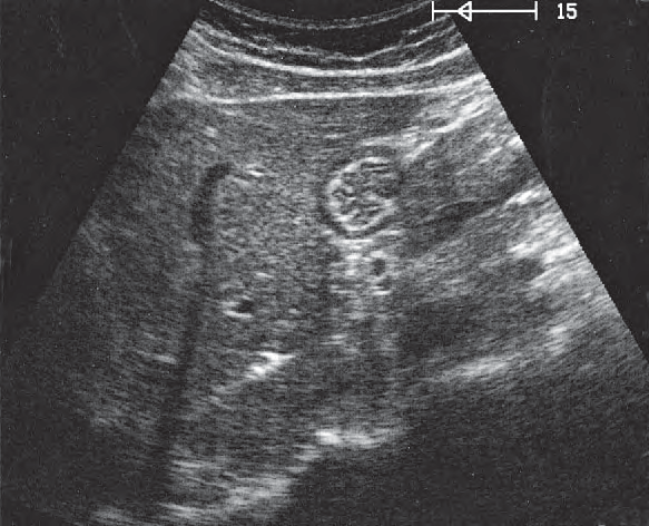 Spinal column ultrasound image, Gastric folds
