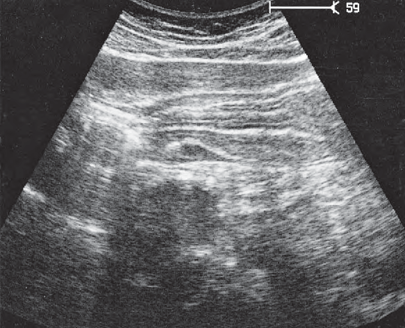 Artifact ultrasound image, Gastric folds